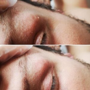 elektrokoagulacja włókniaka z powieki