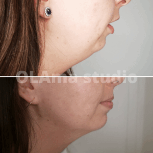 lipoliza iniekcyjna podbródka2