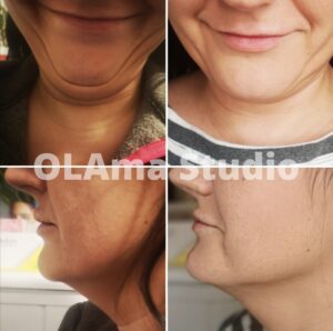 lipoliza podbródka1