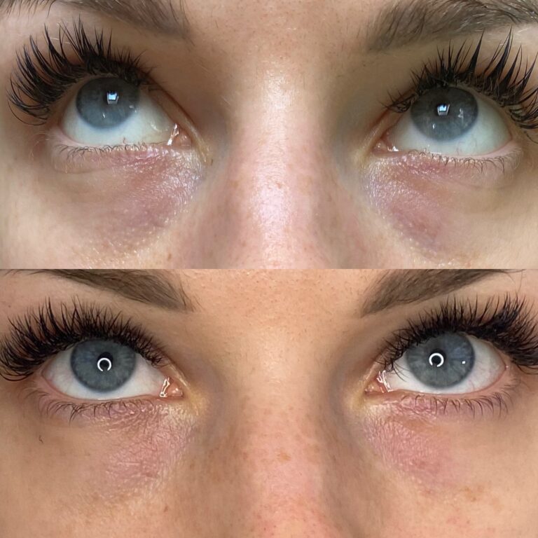 mezoterapia igłowa powieki dolnej