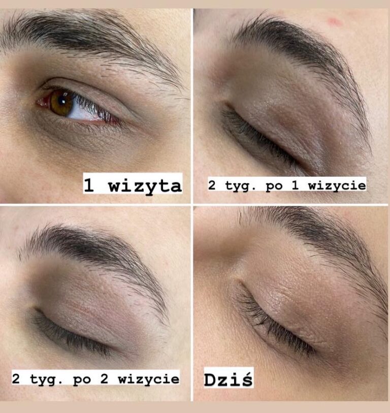 mezoterapia okolicy oka