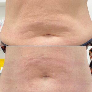 radiofrekwencja mikroigłowa