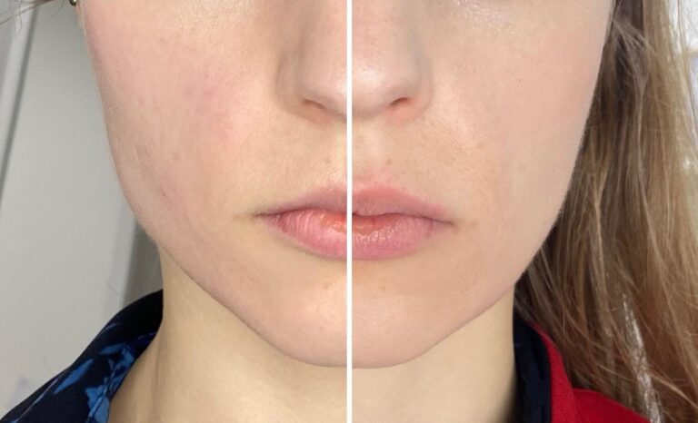 radiofrekwencja mikroigłowa i stymulatory tkankowe