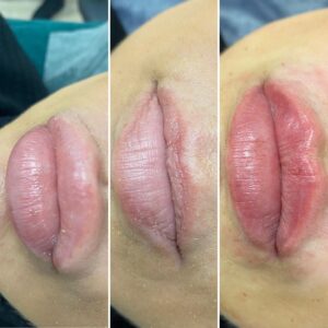 ratunek po nieprawidłowym wypełnieniu w innym gabinecie tj. hialuronidaza i ponowne wypełnienie