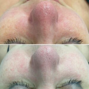 redukcja rumienia na 1 wizycie