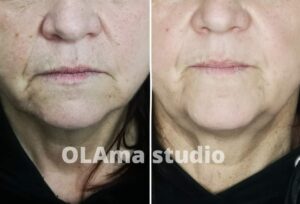 efekt zastosowania stymulatorów tkankowych drogą mezoterapii igłowej