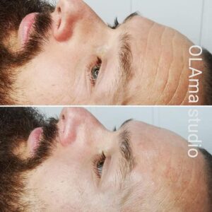 zabieg all inclusive