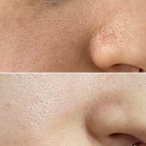 oczyszczanie wodorowe4