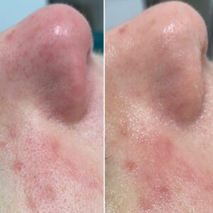 redukcja stanu zapalnego na 1 wizycie