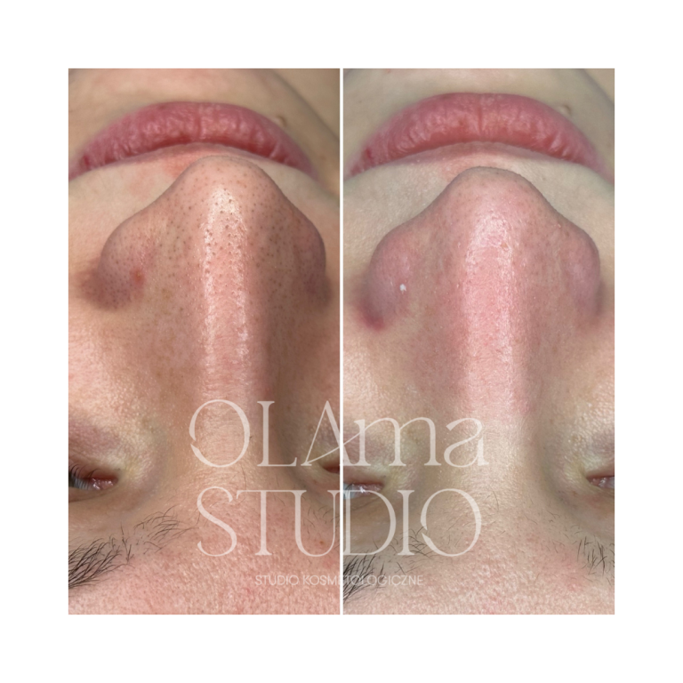 oczyszczanie wodorowe