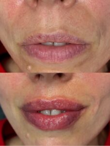 BOTOX A KWAS HIALURONOWY - USTA CZY TWÓJ PARTNER ZNA RÓŻNIC_ - 9